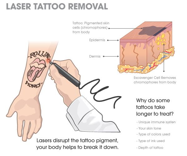 How Laser Tattoo Removal Works - The Wolves Den The Wolves Den How Laser Tattoo Removal Works - The Wolves Den The Wolves Den